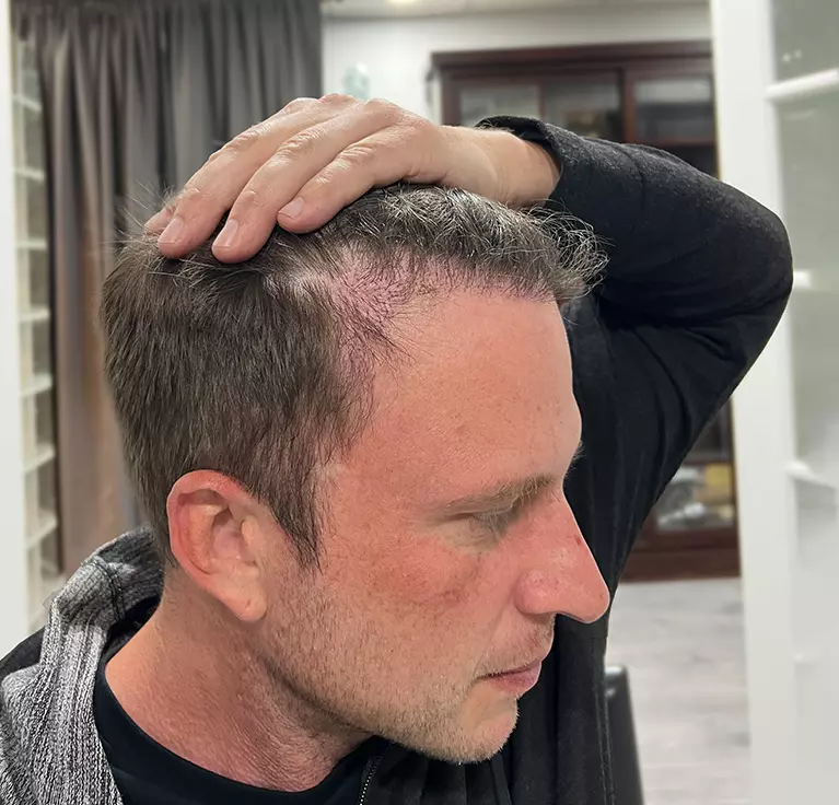 Follicular Unit Extraction (FUE) for Men